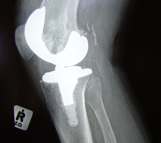 Thumbnail image for Thumbnail image for knee replacement.jpg